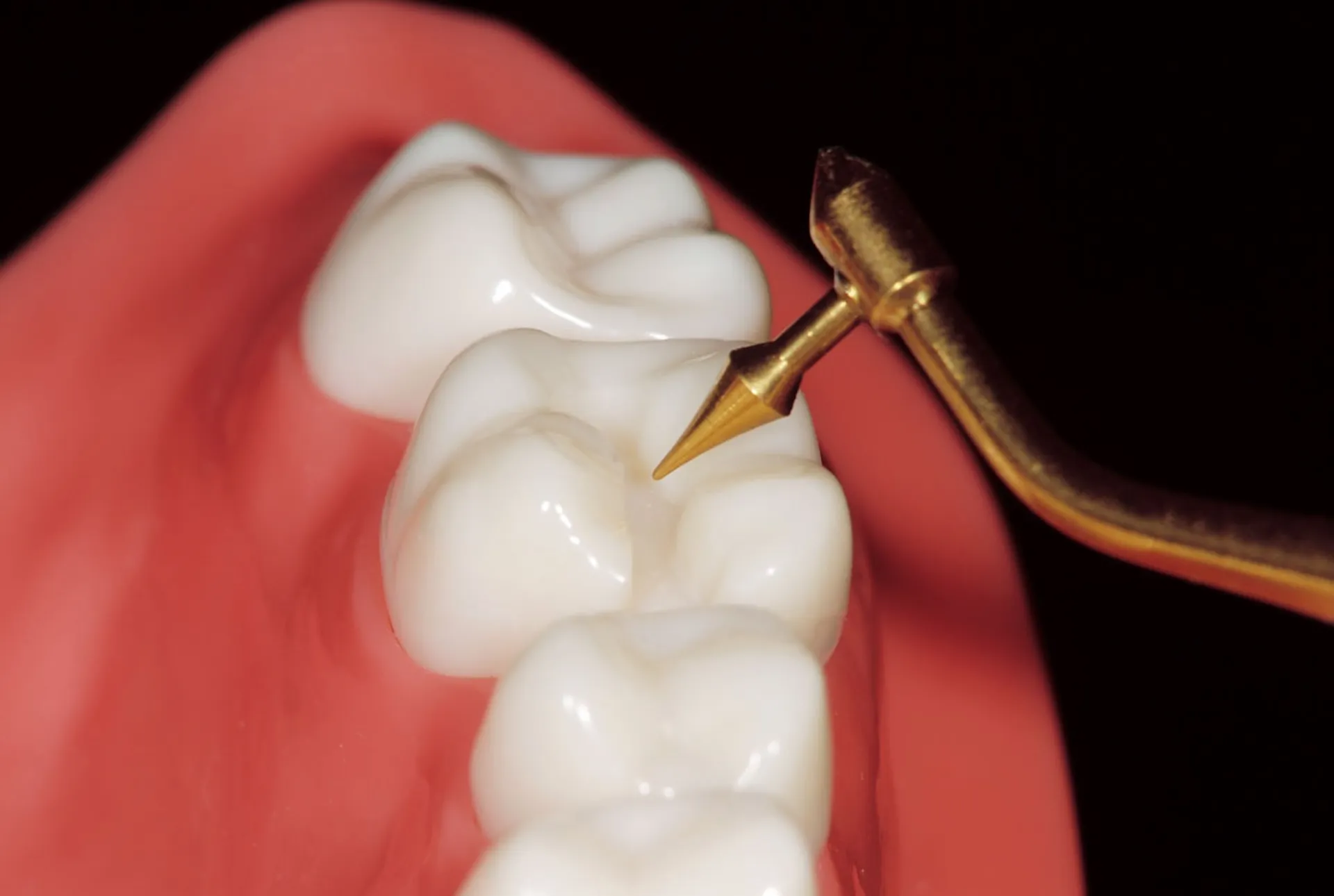 Custom-made dental devices